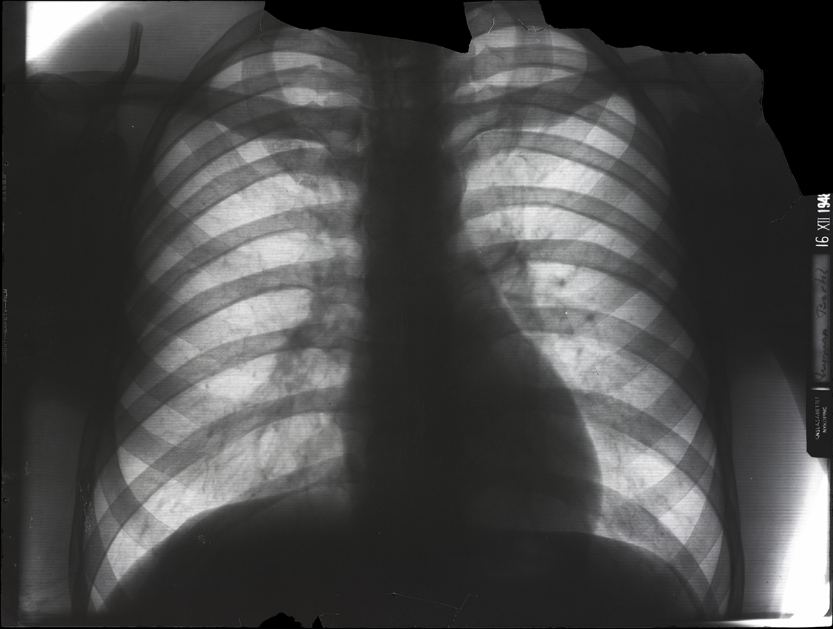 SLM 37914, X10-066, X10-067 - Två röntgenbilder, lungor, från 1948