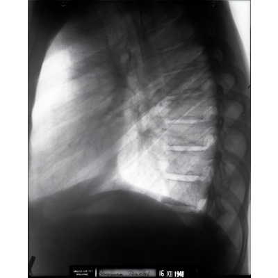 SLM 37914, X10-066, X10-067 - Två röntgenbilder, lungor, från 1948